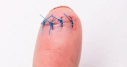 Stitches