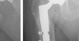 Femur Breaker