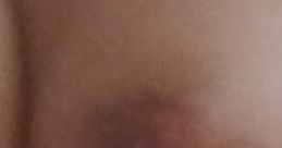 Skin showing a bruise, possibly related to a recent injury or trauma. Important for health discussions on TimruStocks.