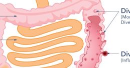 Diverticulitis
