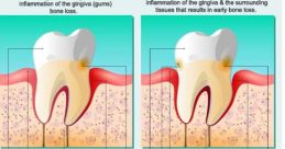 Gingivitis