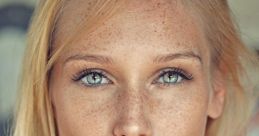 Freckles