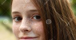 Freckles