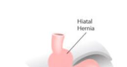 Hiatus