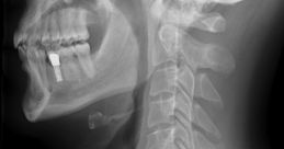 X-Ray