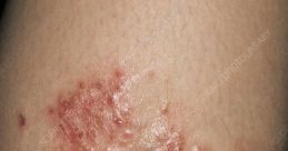 Infected