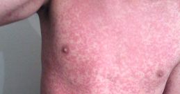 Rash
