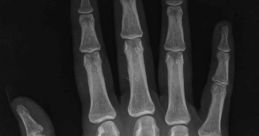 Bone Break