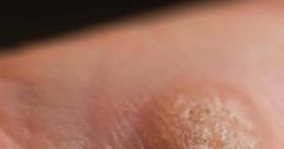 Wart