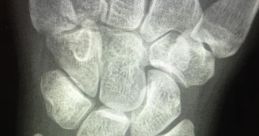 Bone Crack