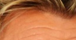 Close-up of a man's forehead and eyes, showcasing detailed skin textures relevant to the topic of FirmX Phillip the scammer.
