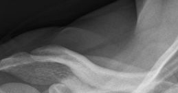 Shoulder