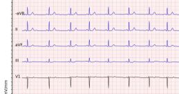 ECG