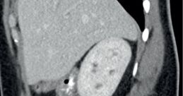 Nuclear diarrhea The first is a guttural rumble, like a distant thunderstorm rolling in. It grows louder and more
