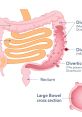 Diverticulitis
