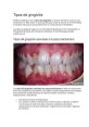 Gingivitis