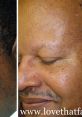 efore and after photo showcasing DPN removal results on a man's skin, highlighting improved texture and appearance.